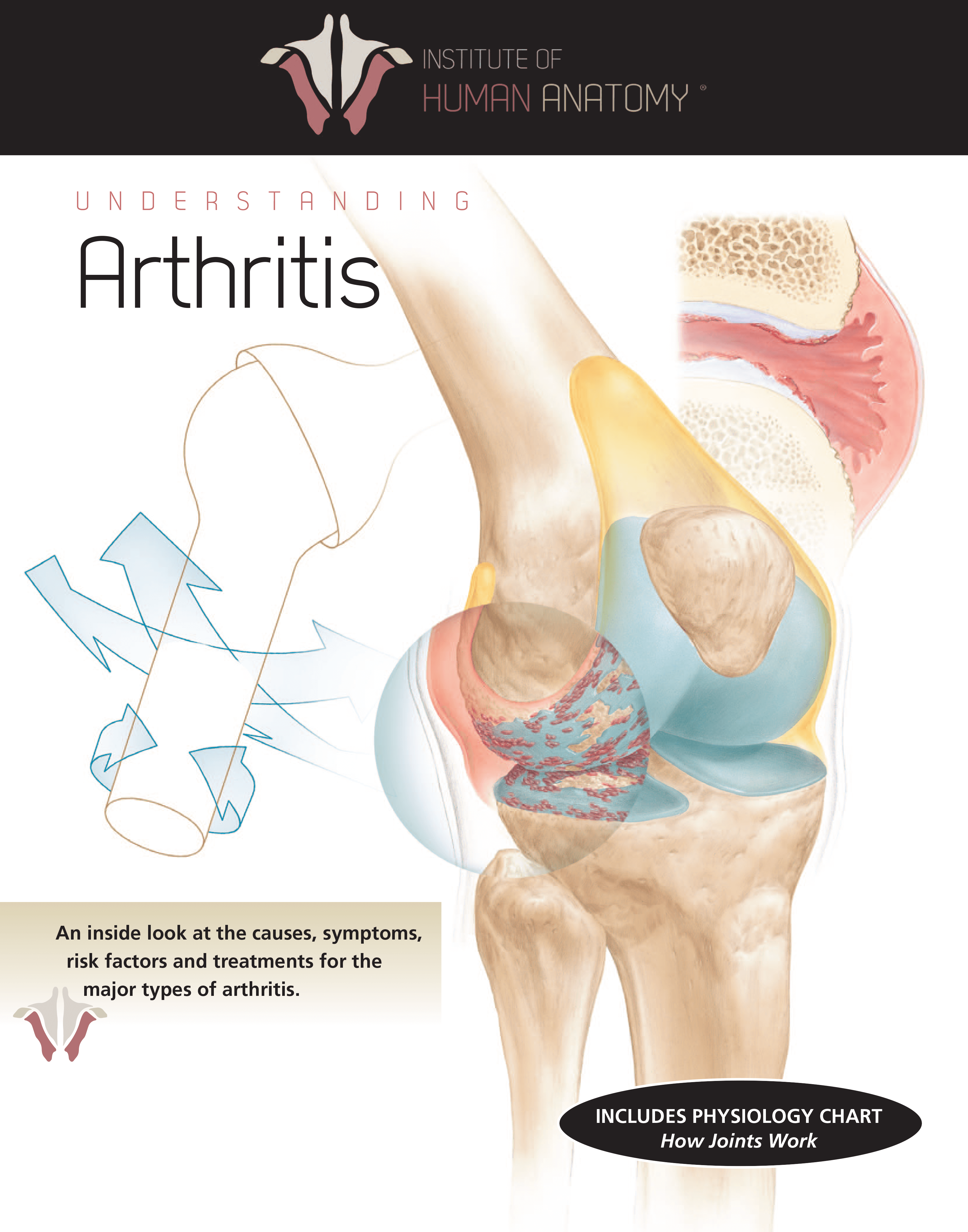 Understanding Arthritis - eBook